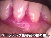 ブラッシング指導前の染め出し