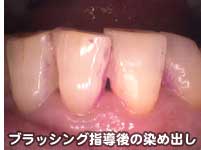 ブラッシング指導後の染め出し