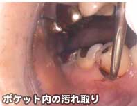 ポケット内の汚れ取