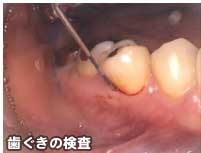 歯ぐきの検査