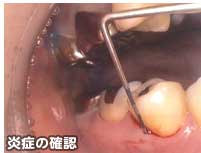 炎症の確認