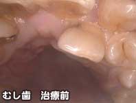 むし歯　治療前