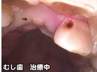 むし歯　治療中