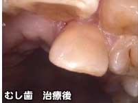 むし歯　治療後